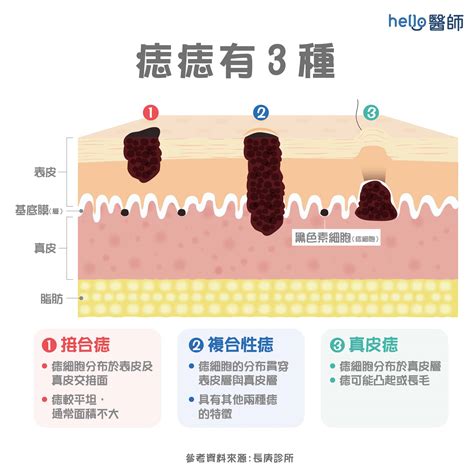 痣長毛代表什麼|為什麼臉上的痣越來越多？皮膚科醫師解析長痣原因、。